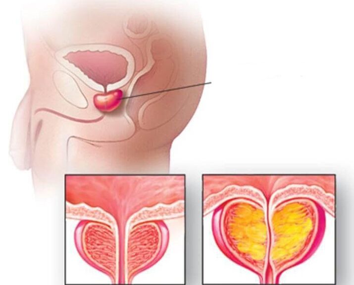 The location of the prostate gland is enlarged in normal prostate and chronic prostatitis