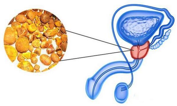Problems related to prostatitis