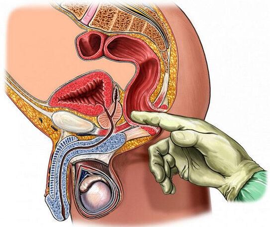 Prostatitis diagnosis